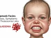 Chipmunk Facies: Causes, Symptoms, and Thalassemia Links Chipmunk Facies